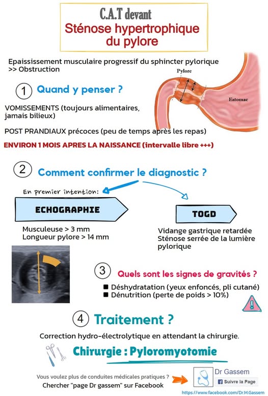 Sténose hypertrophique du pylore